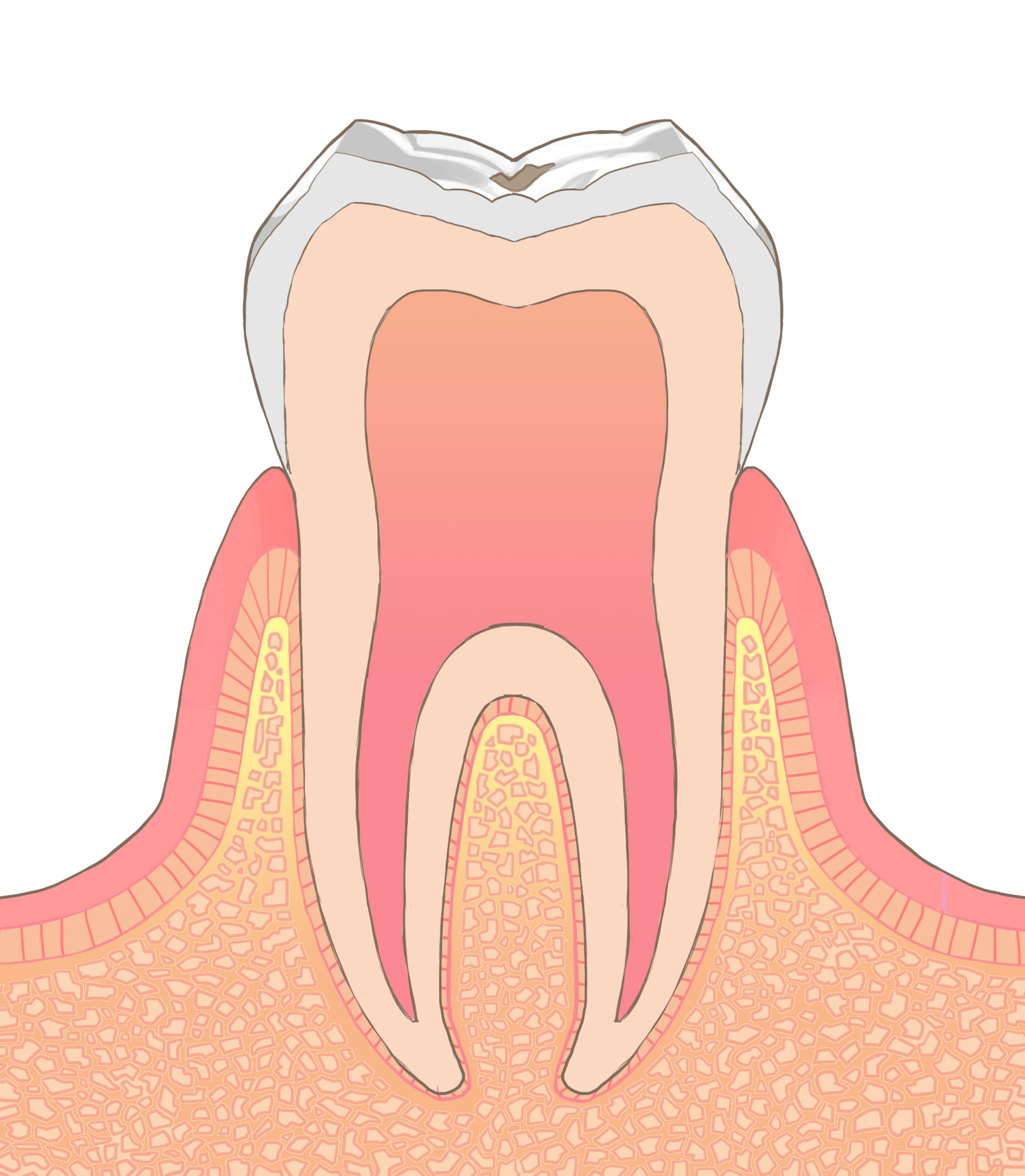 C0　超初期虫歯