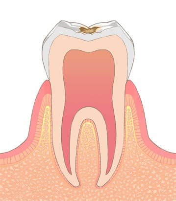 C1　エナメル質の虫歯