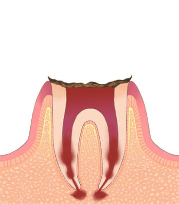 C4　歯根にまで達した虫歯