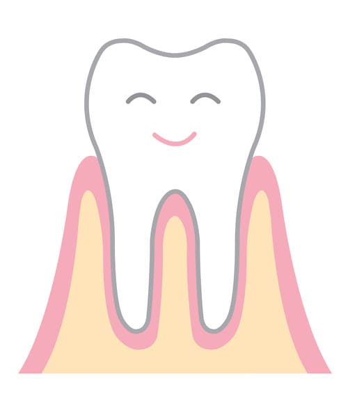 初期歯周病の進行