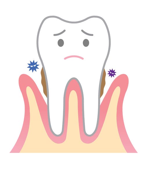 中期歯周病の進行