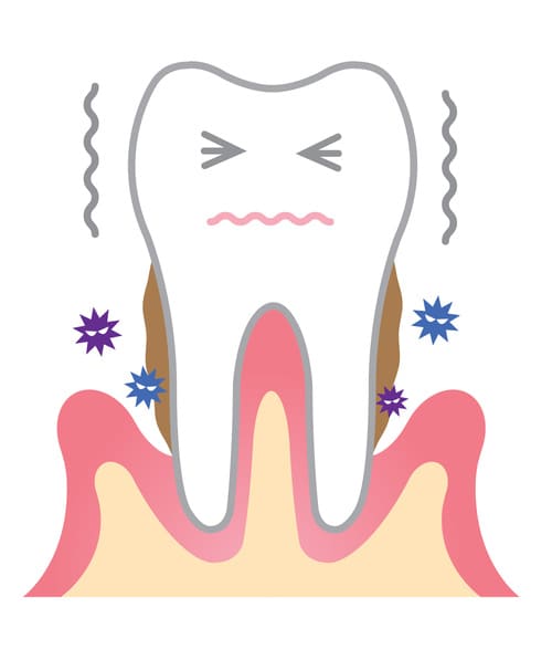 重度歯周病の進行と治療