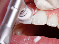 予防歯科・PMTC