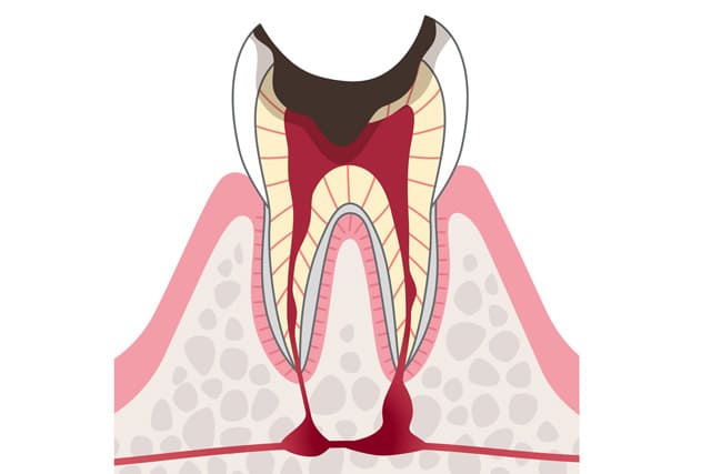 根管治療をせずに抜歯した方が良いのはどんな場合か